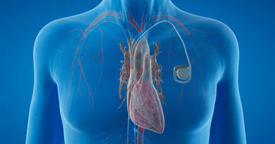 Biocompatible Conductive Gasket Materials for Implantable Devices